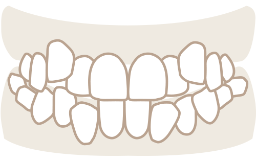 八重歯・歯並びがでこぼこ